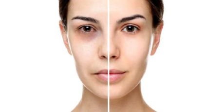 Secretos infalibles para combatir tus ojeras