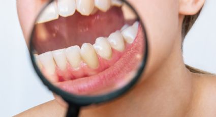 Adiós al sarro: el método más seguro y efectivo para una sonrisa saludable